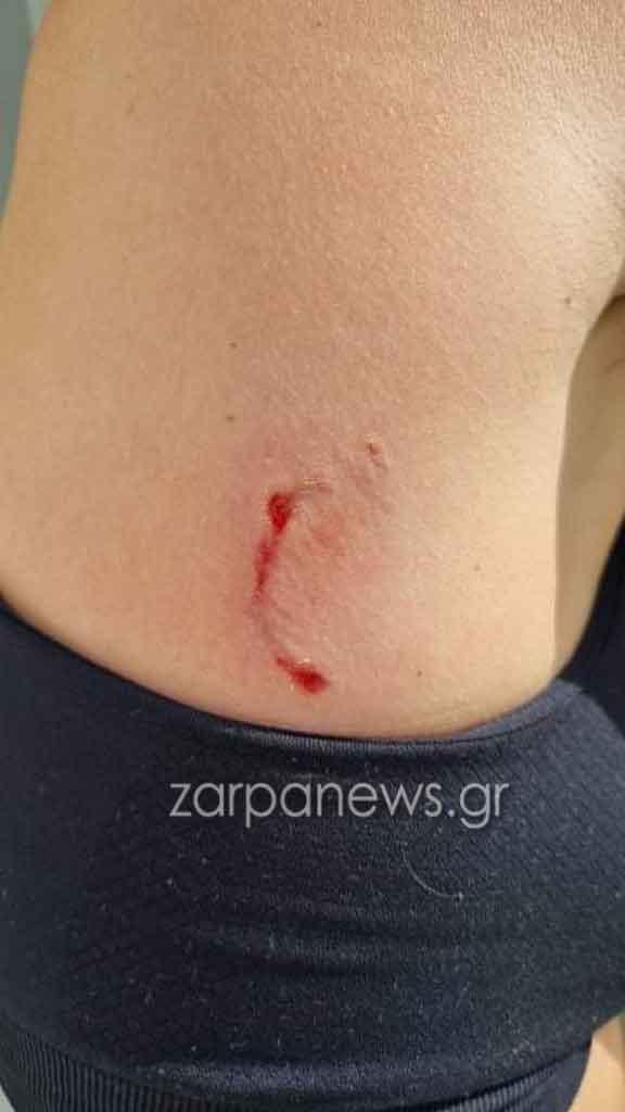 Τραυματισμός γυναίκας από επίθεση σκύλου