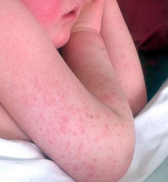 Συναγερμός για τεράστιο κύμα οστρακιάς στην Ευρώπη (pic)