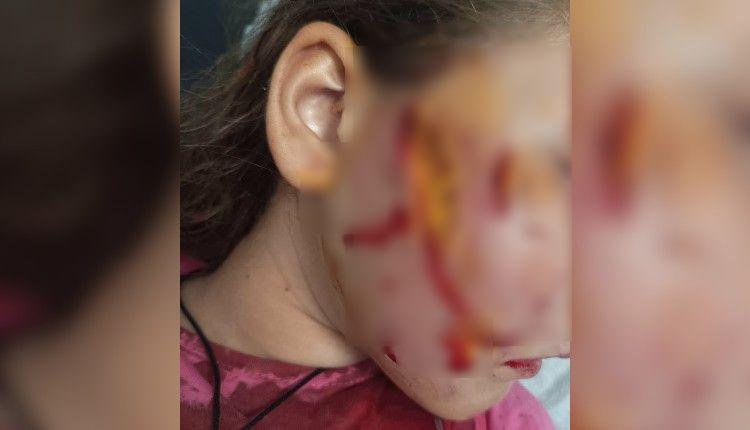 Μεσαρά: Σοκ από την άγρια επίθεση σκύλου σε 7χρονο κοριτσάκι - Η μαρτυρία για τον τραυματισμό της - Δύο συλλήψεις 3 Μεσαρά: Σοκ από την άγρια επίθεση σκύλου σε 7χρονο κοριτσάκι - Η μαρτυρία για τον τραυματισμό της - Δύο συλλήψεις